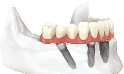 All-on-4 Treatment